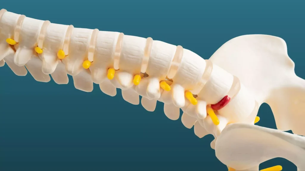 Disco intervertebral