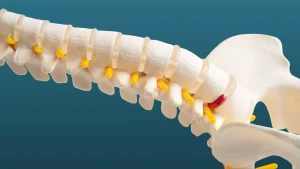 Disco intervertebral