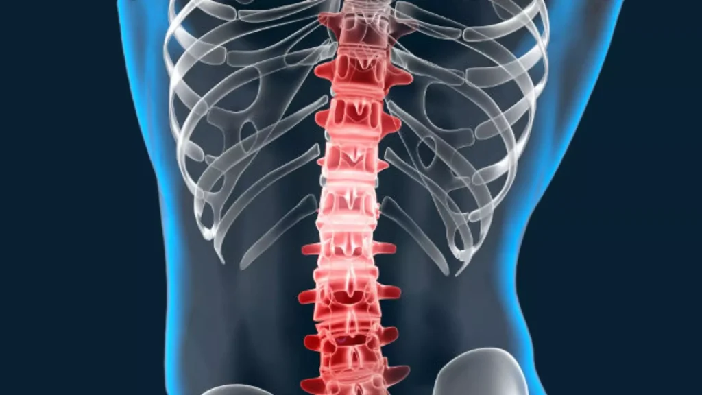 espondiloartritis anquilosante