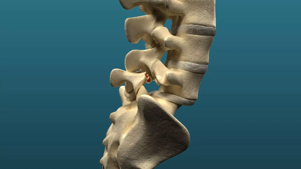 Espondilolistesis degenerativa